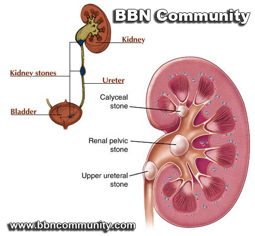 What causes kidney stones 